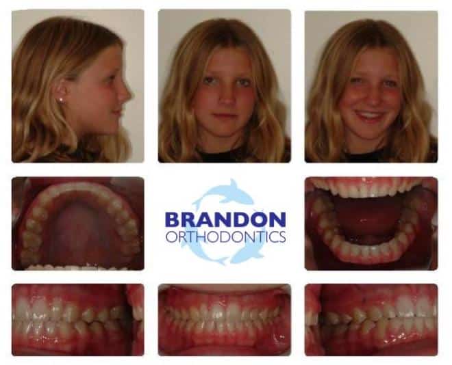 Before and After Gallery Dr. Alex J Brandon. Brandon Orthodontics. Orthodontics, Orthodontic Surgery, Invisalign, Overbites, Retainers, Nightguards. Orthodontist in San Clemente, CA 92673