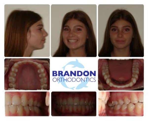 Before and After Gallery Dr. Alex J Brandon. Brandon Orthodontics. Orthodontics, Orthodontic Surgery, Invisalign, Overbites, Retainers, Nightguards. Orthodontist in San Clemente, CA 92673