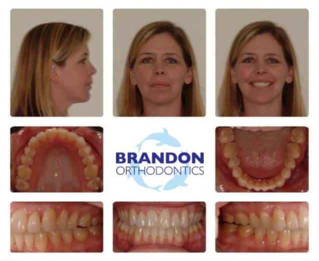 Before and After Gallery Dr. Alex J Brandon. Brandon Orthodontics. Orthodontics, Orthodontic Surgery, Invisalign, Overbites, Retainers, Nightguards. Orthodontist in San Clemente, CA 92673