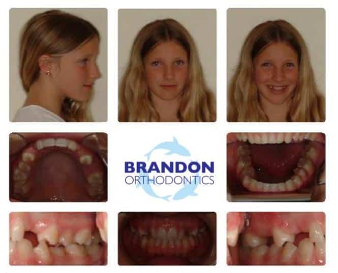 Before and After Gallery Dr. Alex J Brandon. Brandon Orthodontics. Orthodontics, Orthodontic Surgery, Invisalign, Overbites, Retainers, Nightguards. Orthodontist in San Clemente, CA 92673