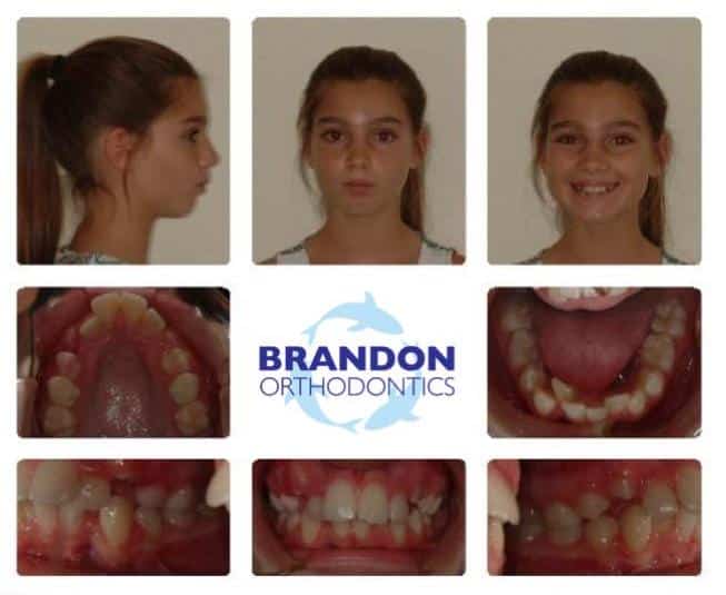 Before and After Gallery, Brandon Orthodontics