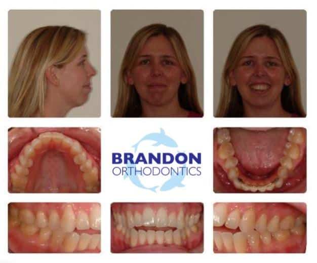 Before and After Gallery Dr. Alex J Brandon. Brandon Orthodontics. Orthodontics, Orthodontic Surgery, Invisalign, Overbites, Retainers, Nightguards. Orthodontist in San Clemente, CA 92673
