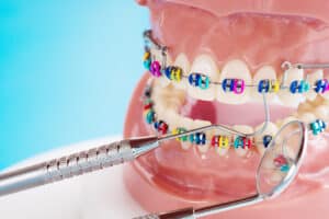 Traditional Braces in San Clemente